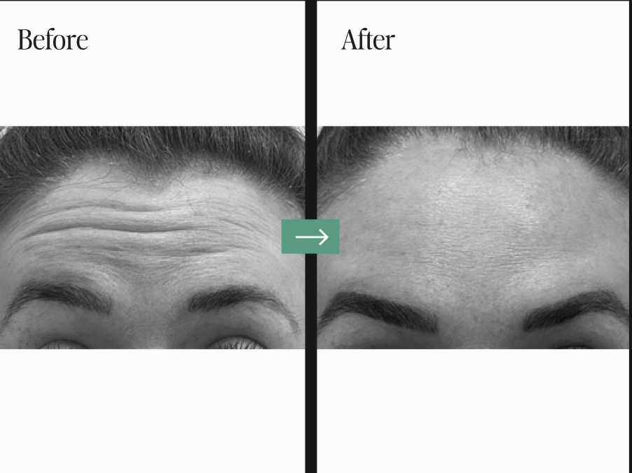 Dermal Fillers and Injectables Before and After Pictures Charleston County, SC